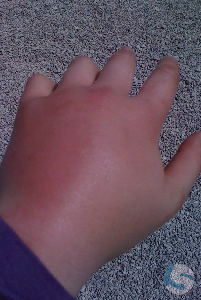 A swollen hand - Wasp stings and diving don't mix